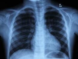 Pot fuma înainte de fluorografie (posibil) Pot să fumez înainte de fluorografie
