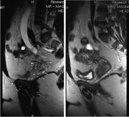 IRM a organelor pelviene la femei, pregătire, RMN cu contrast (corpuri) IRM a organelor pelviene la femei, pregătire, RMN cu substanță de contrast