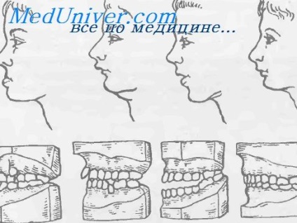 Malocclusion (malocluziilor caracterizat) malocluzia