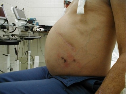 Complicațiile de ciroză hepatică (regiuni ale tractului gastrointestinal) Complicațiile cirozei