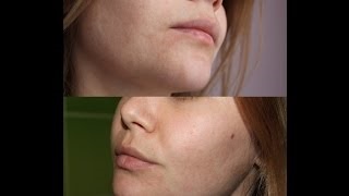 Opinii cojilor acidului salicilic la domiciliu (peeling) Opinii cojilor acidului salicilic la domiciliu
