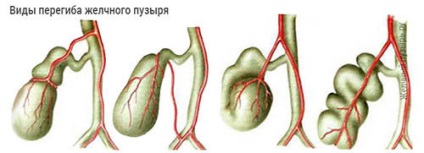 Inflexiunea a vezicii biliare, simptome, cauze, consecinte, tratamentul vezicii biliare genunchiului la adulți (inflexiune) Inflexiunea vezicii biliare, simptomele, cauzele, consecintele, tratamentul genunchiului vezicii biliare la adulți