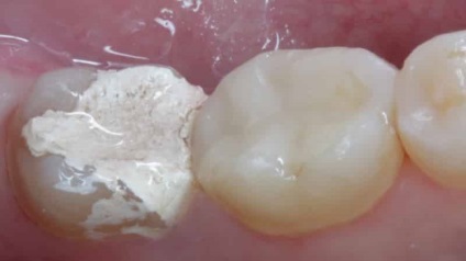 Sigiliul pe tipurile umpluturii dentare fotografie (specii) Tiparire pe un dinte Foto tipuri de sigilii