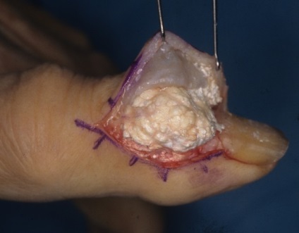 Gout (artrita gutoasă) cauze, simptome, tratament (e) pentru Gout (artrita gutoasă) cauze, simptome, tratament