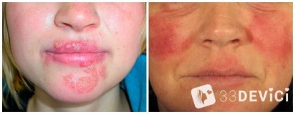 Coji de salicylic pentru față de lectură, fotografii și recenzii (peeling) Coji de salicylic pentru față de lectură, foto, comentarii