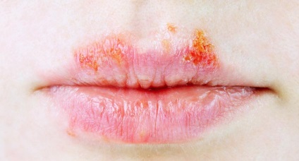 Peelingul salicylic pentru față la domiciliu și salon de comentarii (salicilic) Peelingul salicylic pentru față la domiciliu și salon de comentarii