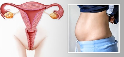 Serozometra la femeile aflate la menopauza - ceea ce este simptome și tratament (fluid de cavitatea uterină) Serozometra la femeile aflate la menopauza - ceea ce este simptome și tratament