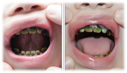 Date dentitie, simptome dentitie și măsuri pentru a elimina simptomele nedorite (dentiție) Perioada de dentiție simptome dentitie și măsuri pentru a elimina simptomele nedorite