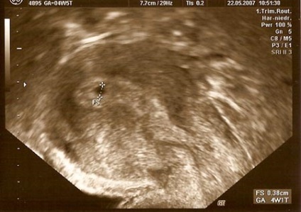 adeziuni intrauterine ce este (adeziuni intrauterine) adeziuni intrauterine ce este