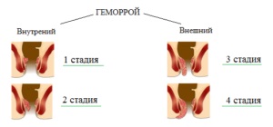 Хронични хемороиди причини, симптоми и лечение