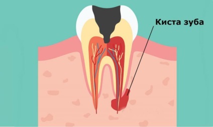 afecțiunilor dentare - clasificarea și tratamentul bolilor dentare (tratament) boli dentare - clasificarea și tratamentul bolilor dinților