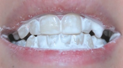 Dentare profesioniști pulbere de albire și contra producătorilor populare, comentarii (dentare) Dentare profesioniști pulbere de albire și contra producătorilor populare, comentarii