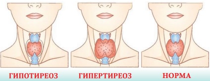 Колкото по-опасно излишъка и дефицита на хормони на щитовидната жлеза