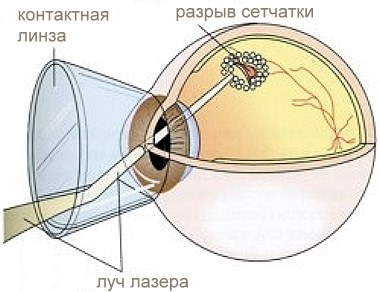 lentilă fundus