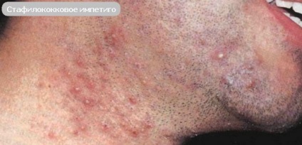 Impetigo - streptococ, buloase și tratament vulgar