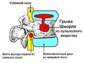 Cum sunt noduri SHmorlja la nivelul coloanei vertebrale