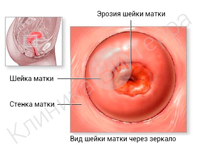 Tratamentul și diagnosticarea bolilor de col uterin