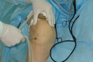 Chirurgie pe meniscul genunchiului reabilitare