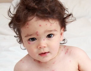 Ваксинирането срещу варицела деца, където и когато да се направи реакцията, усложнения
