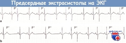 Simptomele de aritmie atrială în ECG