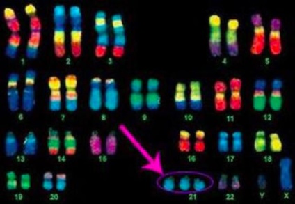 Sindromul Down, de ce apare si cum sa evite explica genetica