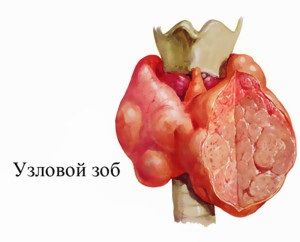 Видове на щитовидната жлеза гуша
