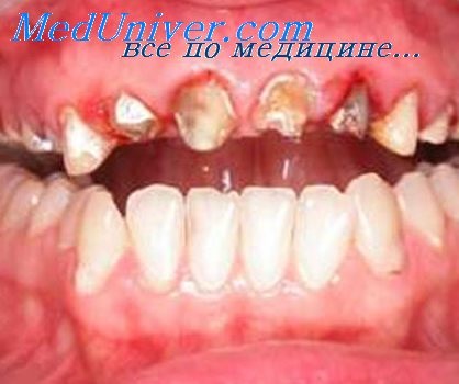 Antibiotice în tratamentul parodontitei (antibiotice pentru tratamentul periodontitei) Antibioticele în tratamentul parodontitei