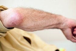 eczema atopica (scalp) eczema atopica