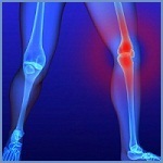 Osgood-Schlatter boala (osteohondropatija tuberozitatea tibială) (tibial) Boala Osgood-Schlatter (osteohondropatija tuberozitatea tibială)