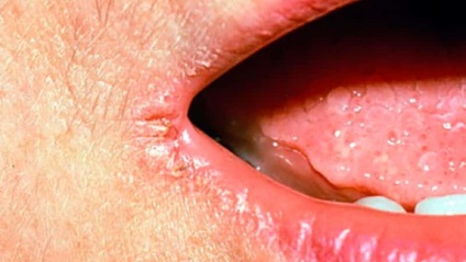 Sore pe buze, dar nu herpesului decât vindecarea (cura) Sore pe buze, dar nu herpes decât vindecarea