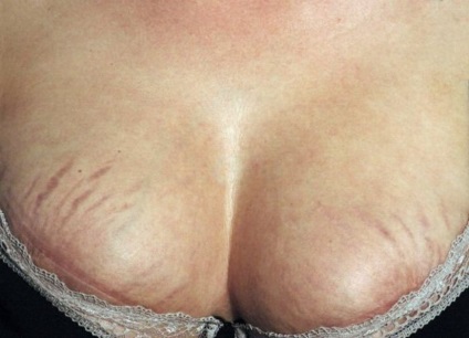site-ul Tselebnik medicina tradițională - cum să eliminați vergeturi pe sâni (stretching) site-ul Tselebnik medicina tradițională - cum să eliminați vergeturi pe sâni