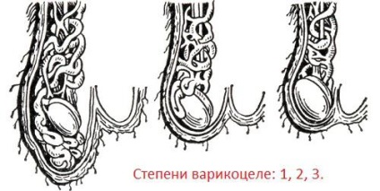 Pericolul varicocelului la bărbați (de sex masculin) Pericolul varicocel la bărbați