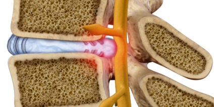 Ceea ce este diferit de proeminența de hernie de disc intervertebral (hernie) Ceea ce distinge proeminența unei hernii de discuri intervertebrale