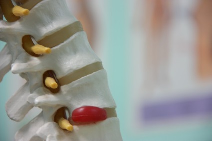 Ceea ce distinge proeminența unei hernii de discuri intervertebrale (CD-uri) Ceea ce distinge proeminența unei hernii de discuri intervertebrale