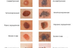 Ce se întâmplă dacă doare mol (soare lung) Ce se întâmplă dacă doare birthmark
