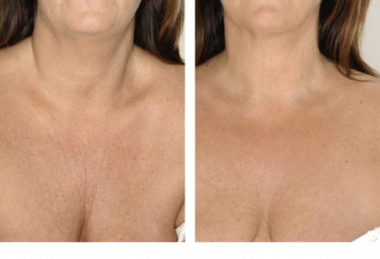 Ce este mezoterapie, avantajele și dezavantajele sale (această clinică procedură estetică) Ce este mezoterapie, avantajele și dezavantajele sale
