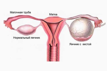 chistadenomul ovarian (mucinos, seroase, papilar) prognozele tratamente