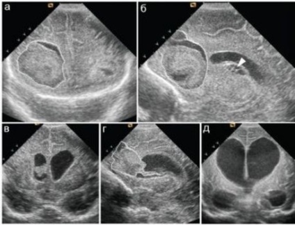 Cubependimalnaya chist în cauze nou-născuți și tratament
