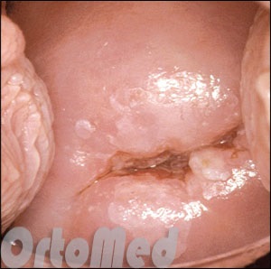 displazie de col uterin, simptome si tratament, 1, 2, 3 grade de displazie cervicală (displazie) displazie de col uterin, simptome și tratament, 1, 2, 3 grade de displazie de col uterin