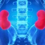Etapa 4 (boala inflamatorie rinichi urinar) Etapa 4