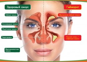 Tratamentul Sinuzita de remedii populare (obligatoriu) remedii populare de tratament Sinuzita