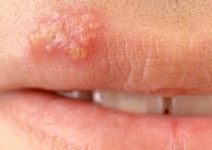 Herpes pe buzele cauzelor și tratamentul (leziuni la rece) Herpes pe buzele cauzele și tratamentul