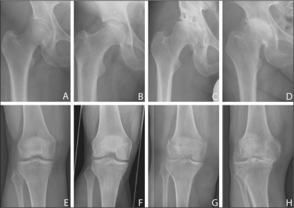Exercitarea cu eficacitate osteoartrita la genunchi (terapie fizica in osteoartrita a genunchiului fizioterapie cu osteoartrita la genunchi exerciții cu osteoartrita de gimnastica articulației genunchiului gimnastica artroză pentru exercitarea artroza genunchiului cu osteoartrita a terapiei fizice articulației genunchiului la artroza genunchiului 2 grade fizioterapie genunchi terapeutice gimnastică LFK gonartroza 2 grade la fizioterapie artroza genunchiului cu osteoartrita genunchiului imn artroza genunchiului gimnastica Stick artroza articulației genunchiului) Gimnastica genunchi eficacitatea artroza