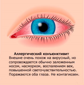 Descrierea eyedrops kromogeksal, contraindicații, aplicație (agent antialergic) Eyedrops kromogeksal descriere, contraindicații, aplicații