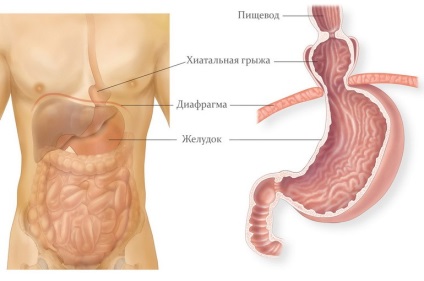 simptome hernie hiatala, cauze, tratamentul (esofagiene) simptome hernie hiatala, cauze, tratament
