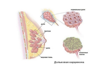 cancerul de sân invaziv este carcinomul ductal simptome, tratament, prognostic (ductal) cancerul de sân invaziv este carcinomul ductal simptome, tratament, prognostic
