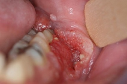 Cum fumatul afecteaza dintii si gingiile fumătorului (foto) (afectează) Cum fumatul afecteaza dintii si gingiile fumătorului (foto)