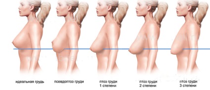 Cum de a restabili forma si fermitatea sanilor după naștere și alăptare (restabilirea) Cum de a restabili forma si fermitatea sanilor după naștere și alăptare