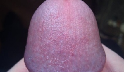 Candida balanoposthitis la barbati fotografie, simptome, tratament, boli fungice (bărbați) Candida balanoposthitis la bărbați fotografie, simptome, tratament, boli fungice