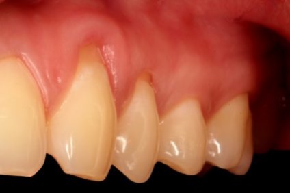 tipuri și caracteristici osteoplasty (tipuri) Grefării osoase, tipuri și caracteristici